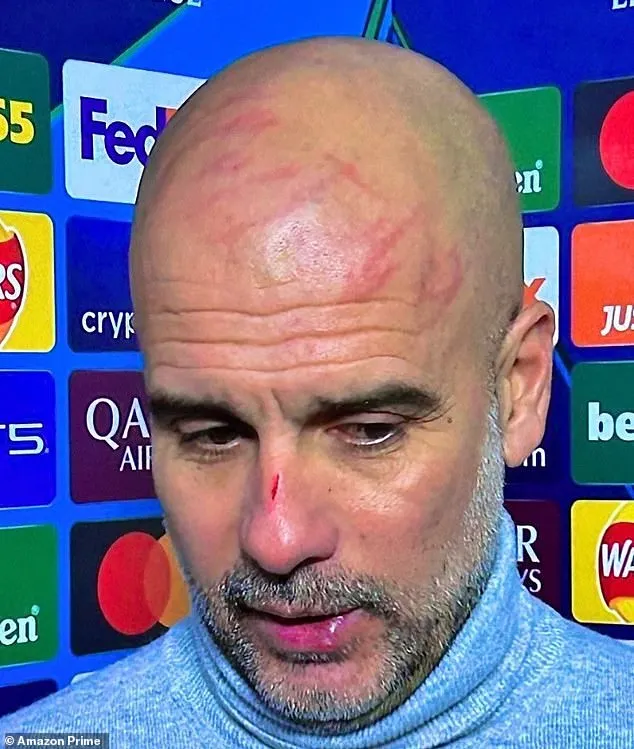 Pep Guardiola's Mysterious Facial Marks: Concerns Rise After Manchester City's Draw