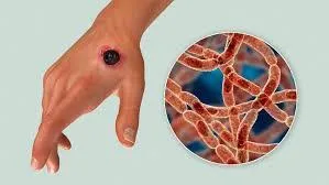 FG Warns Nigerians About Anthrax Outbreak in Zamfara: What You Need to Know