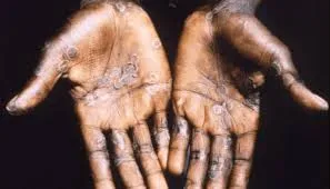 Sierra Leone Confirms First Monkeypox Case: What You Need to Know